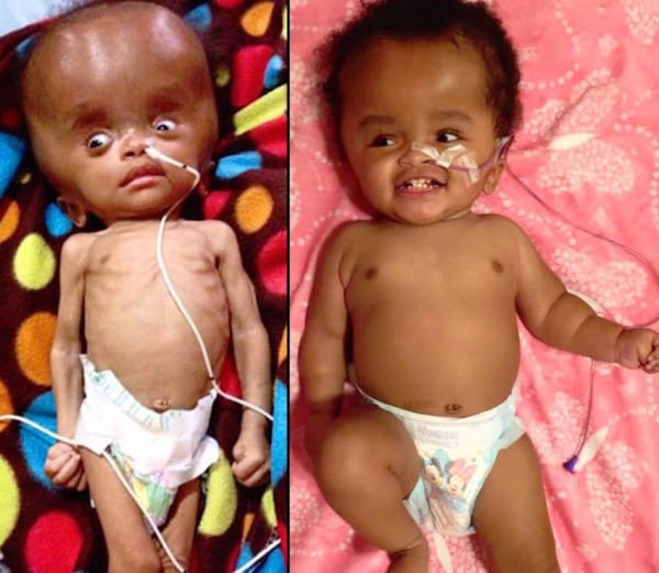 woman adopts baby with brain condition 