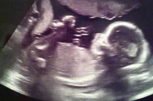 angel in ultrasound 
