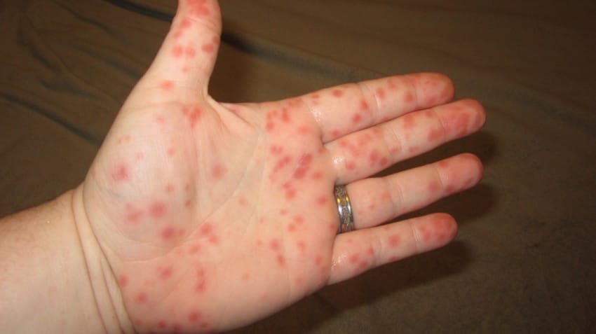hand food and mouth disease