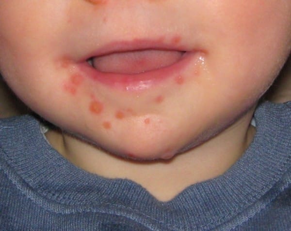 hand food and mouth disease