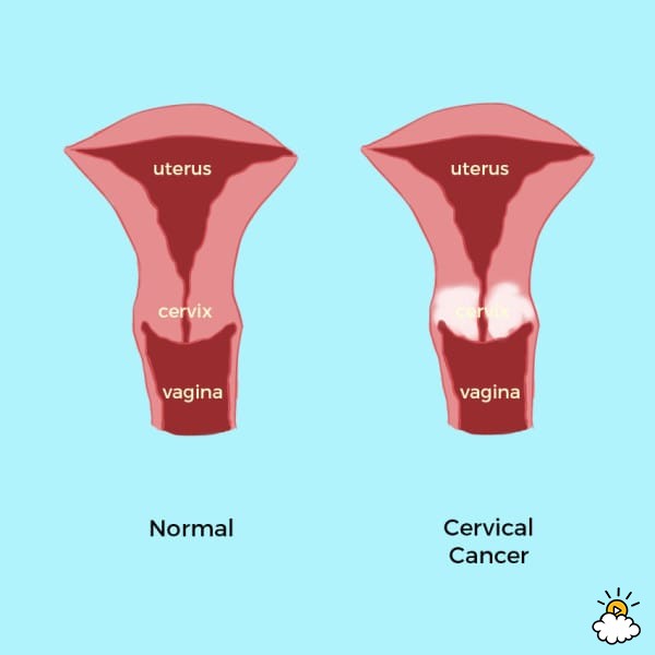 cervical cancer signs