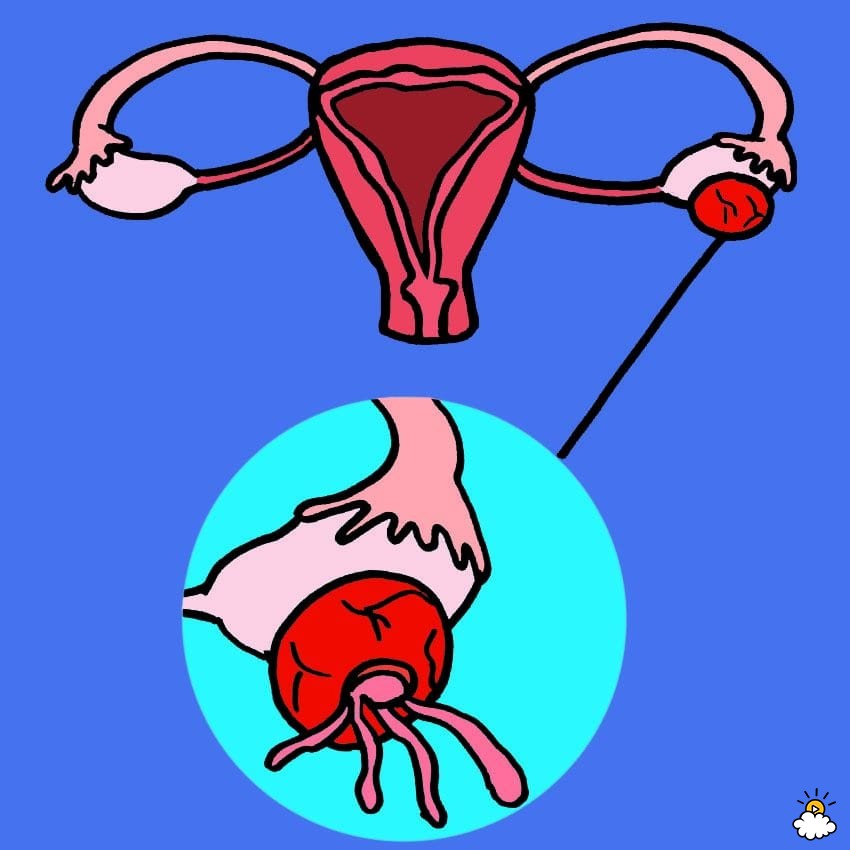 symptoms of ovarian cysts