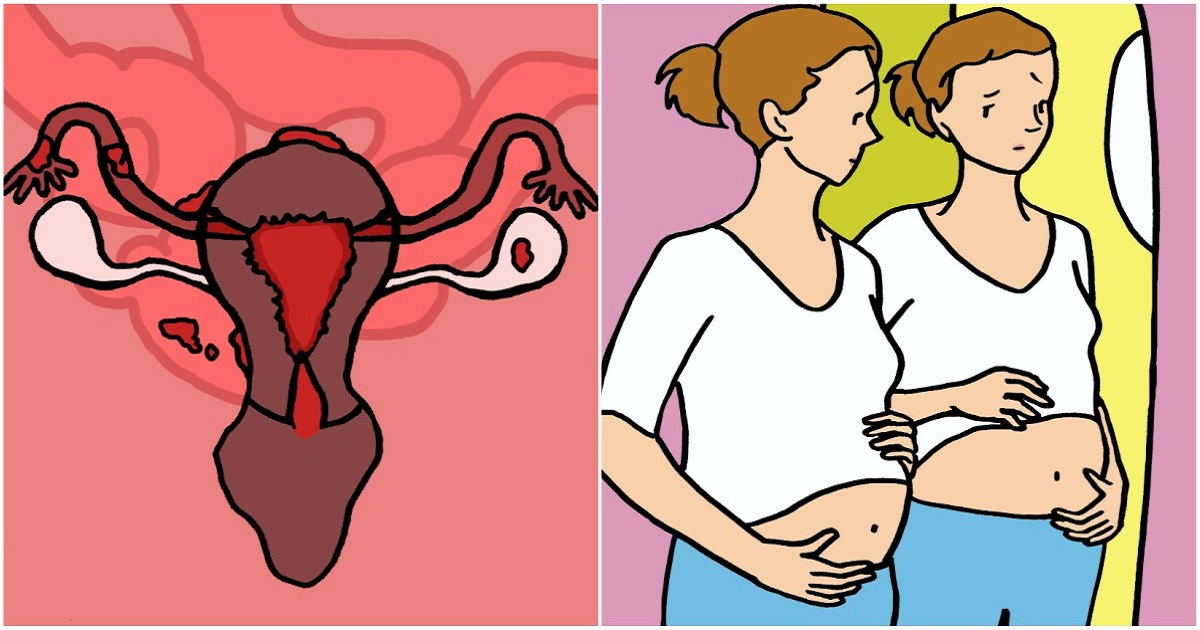 6 Concerning Symptoms Of Ovarian Cysts Women Of All Ages Need To Know About