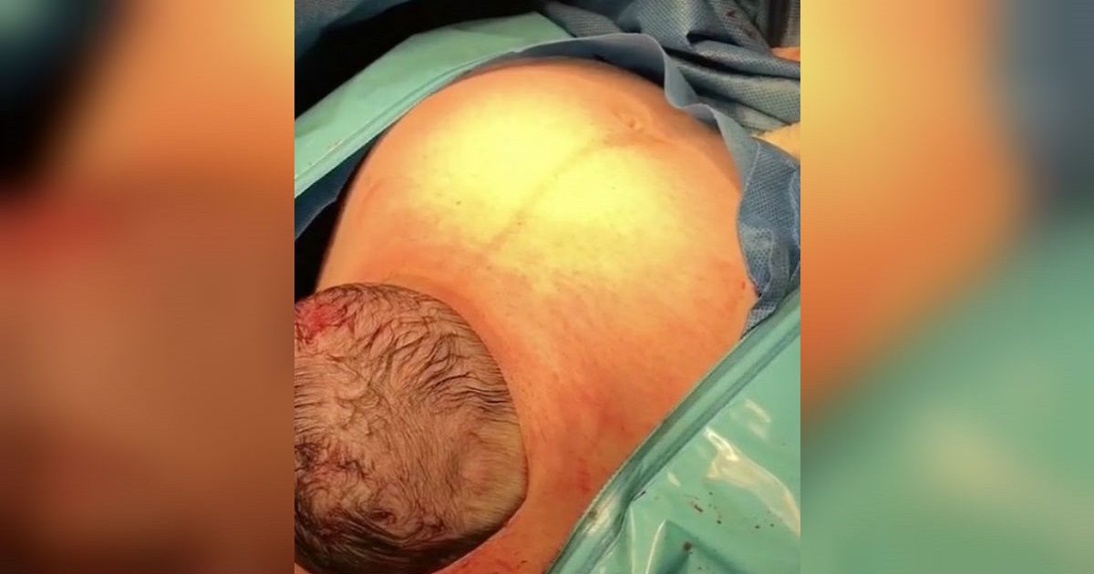 Doctors Carefully Cut Into Mom’s Pregnant Belly, Then Baby’s Head Pokes Through