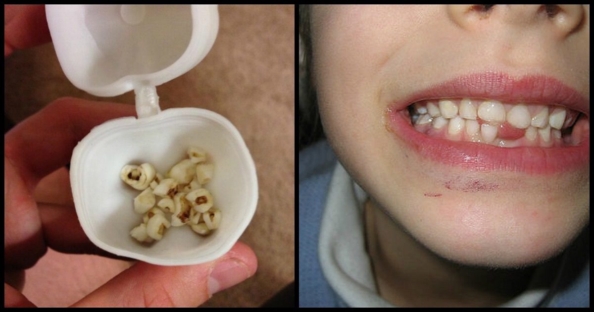 Doctors Are Urging Parents Everywhere To Keep Their Kids’ Baby Teeth