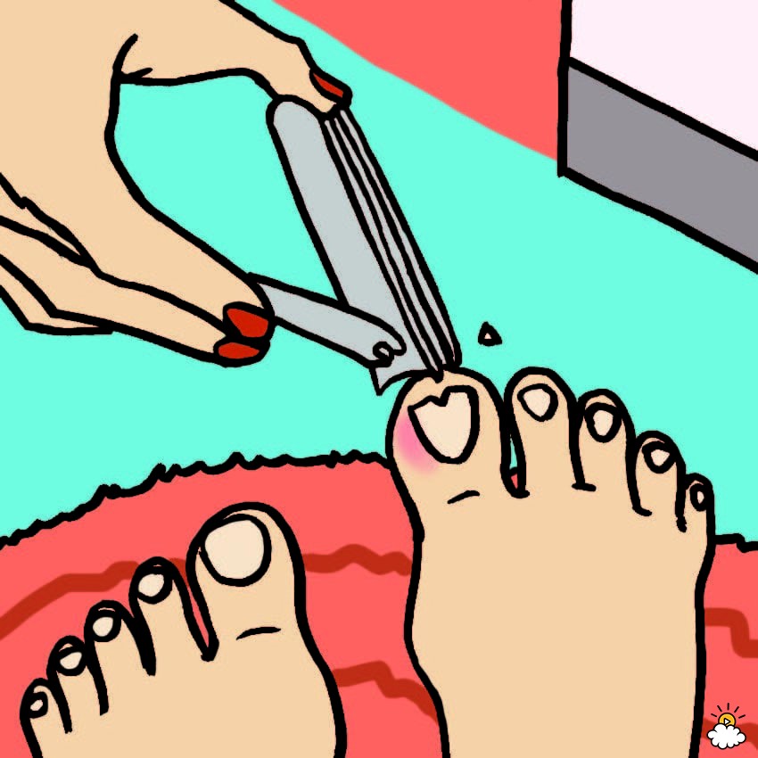 ingrown toenails treatments